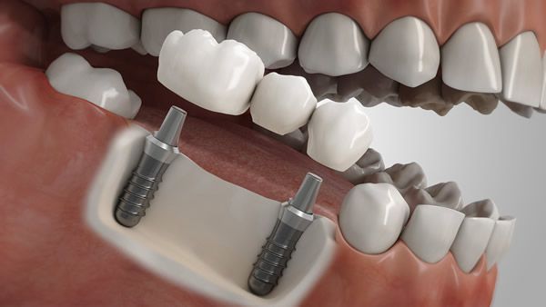 Illustration eines Implantats als Ersatz für mehrere Zähne nebeneinander